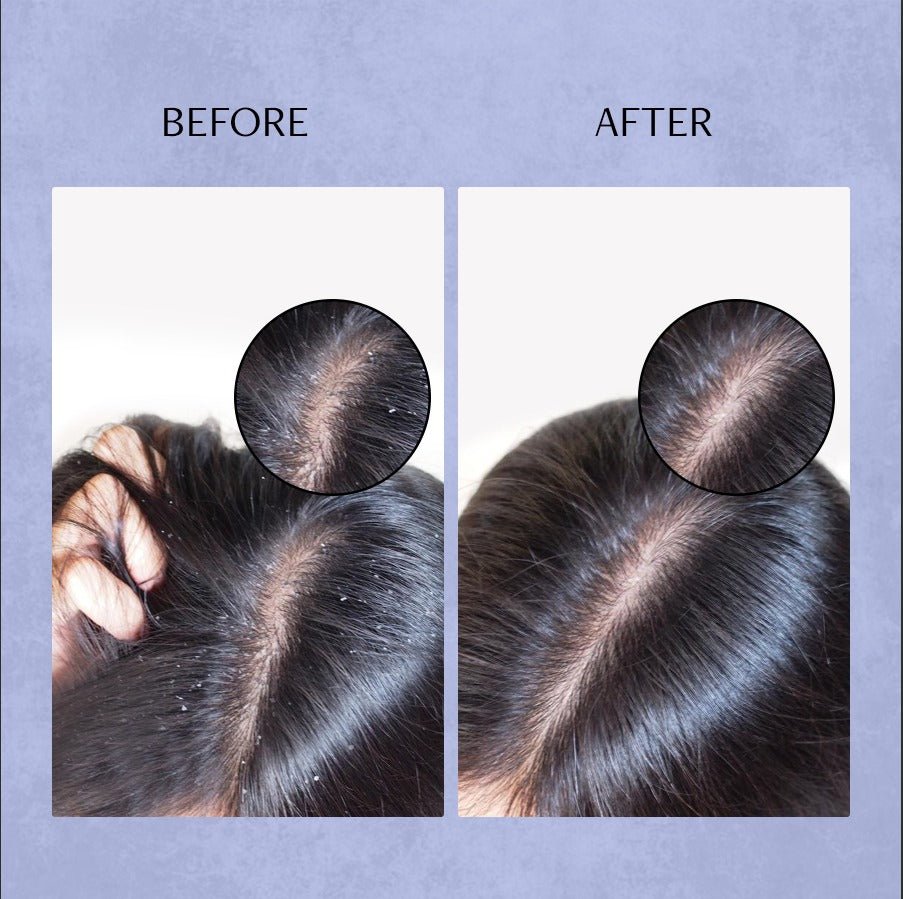 Anti Dandruff Serum for Scalp - 0.5% Piroctone Olamine + 2% Salicylic acid + 1% Prebiotic - thedeconstruct