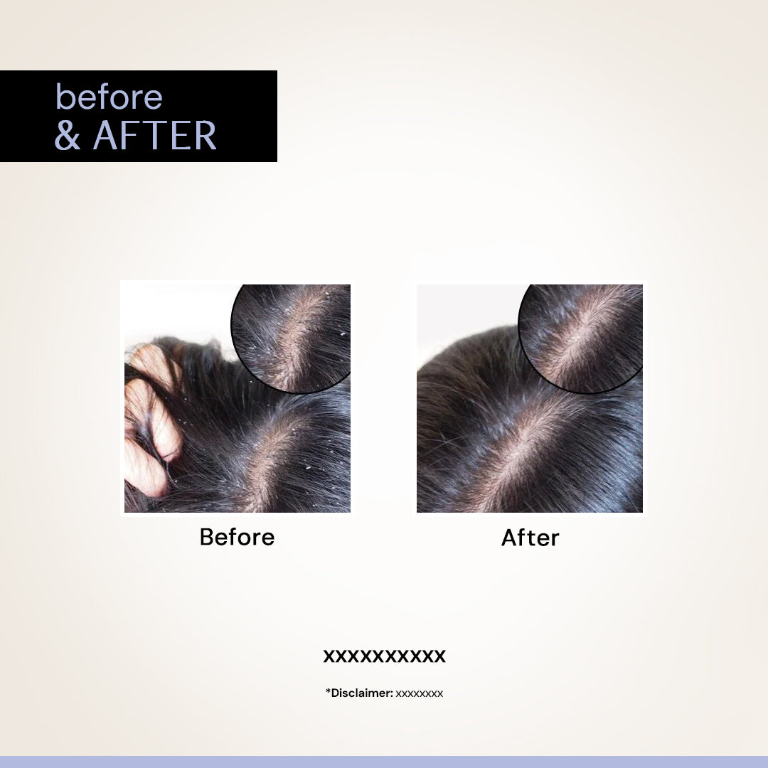 Anti Dandruff Serum for Scalp - 0.5% Piroctone Olamine + 2% Salicylic acid + 1% Prebiotic