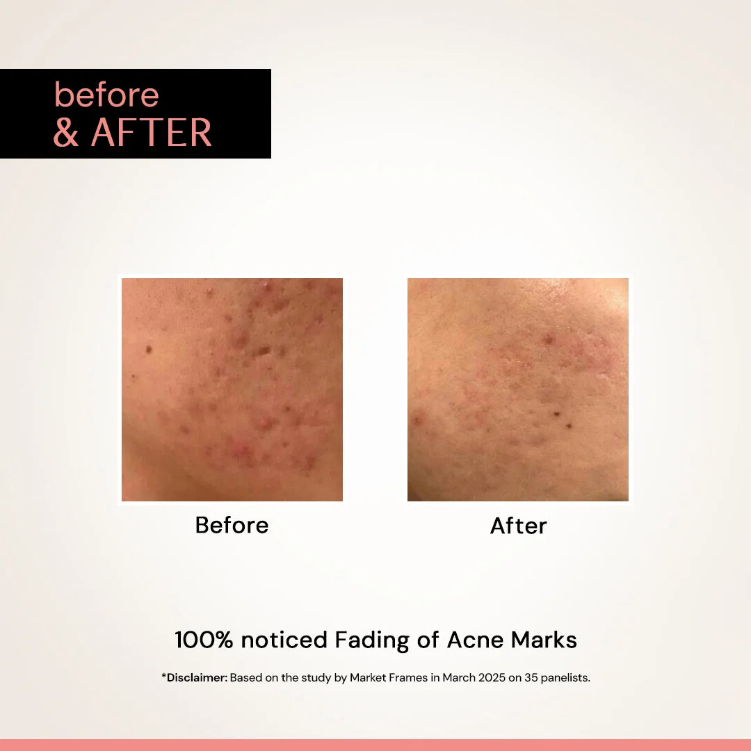 Multi-Benefit Clearing Niacinamide Face Serum | Fades Dark Spots, Pigmentation, Tanning &amp; Acne Marks