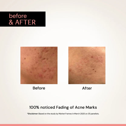 Multi-Benefit Clearing Niacinamide Face Serum | Fades Dark Spots, Pigmentation, Tanning &amp; Acne Marks